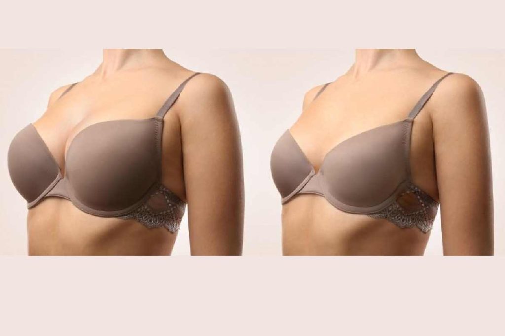 Breast Reduction Procedures